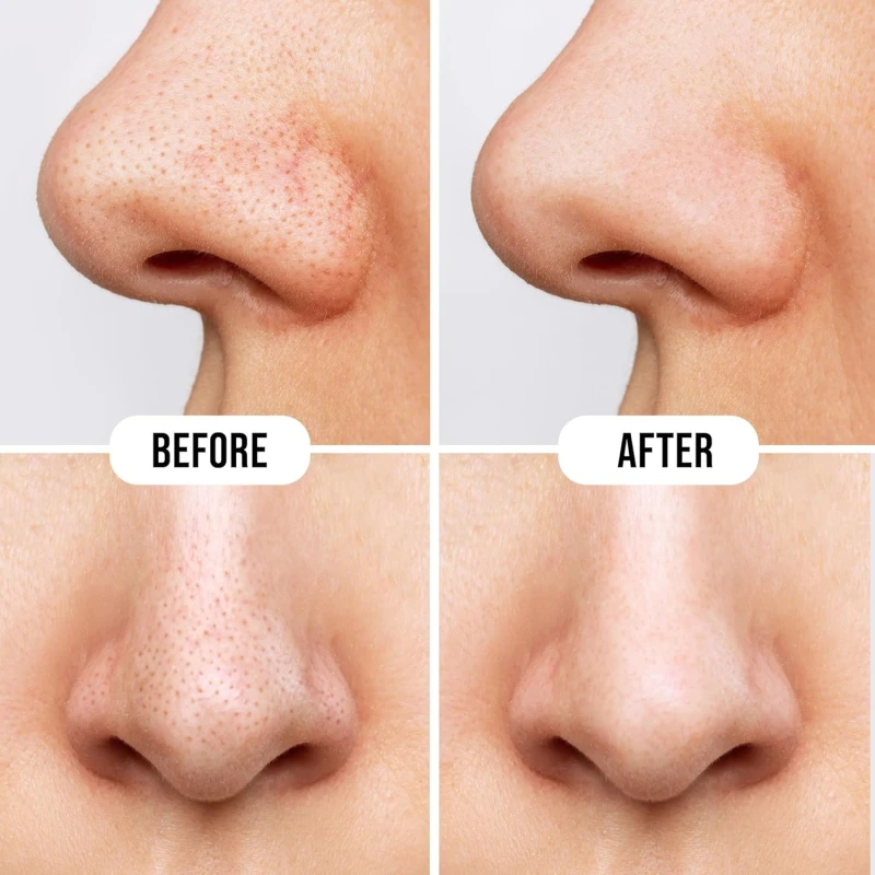 Hilary Rhoda Rose Nose Strips Pack of 10 Strips for Blackhead &amp; Whitehead Remover | Deep Cleansing Pore Strips for Nose | Oil Control Formula SHADE 02) thumbnail 6