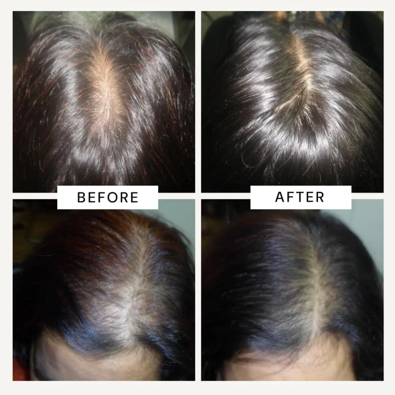 Richfeel Anagrow® Advanced Hair Regrowth Serum – A Swiss Formula • Controls Hair Fall • Stimulates Regrowth • Boosts Density • Lightweight Formula (2x15ml) thumbnail 5