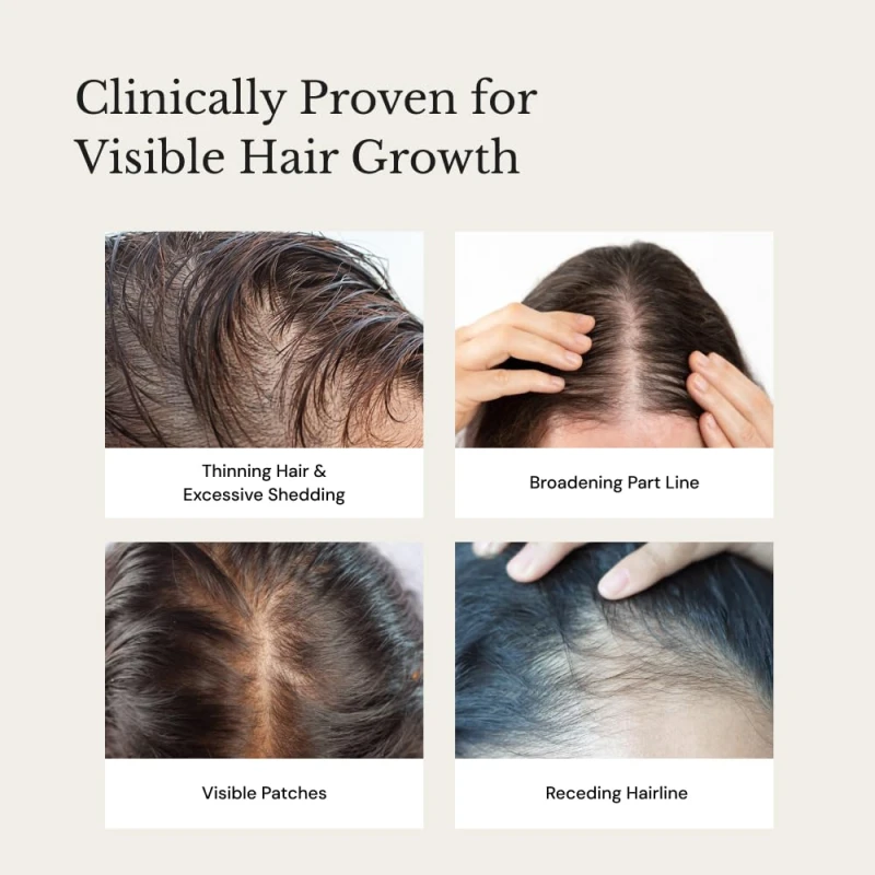 Richfeel Anagrow® Advanced Hair Regrowth Serum – A Swiss Formula • Controls Hair Fall • Stimulates Regrowth • Boosts Density • Lightweight Formula (2x15ml) thumbnail 6